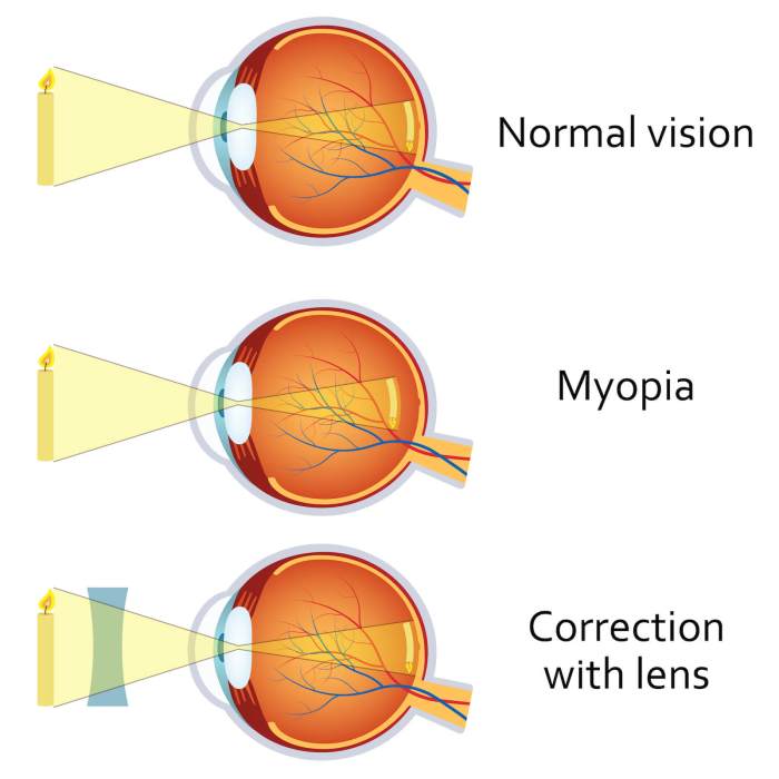 Cynthia's myopia is commonly referred to as