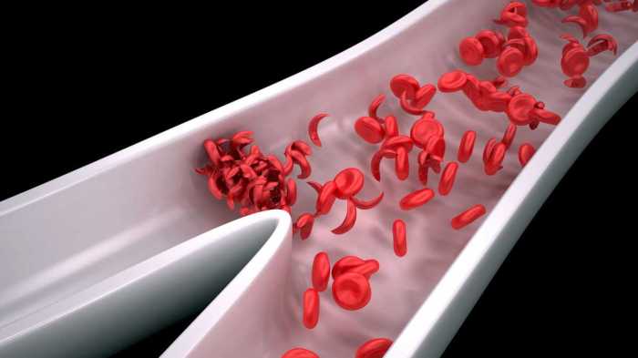 Sickle cell anemia hesi case study